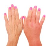 Two female hands side by side, one swollen