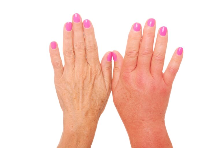 Two female hands side by side, one swollen